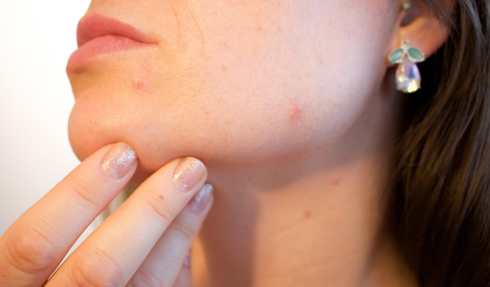 Acne and Oily Skin